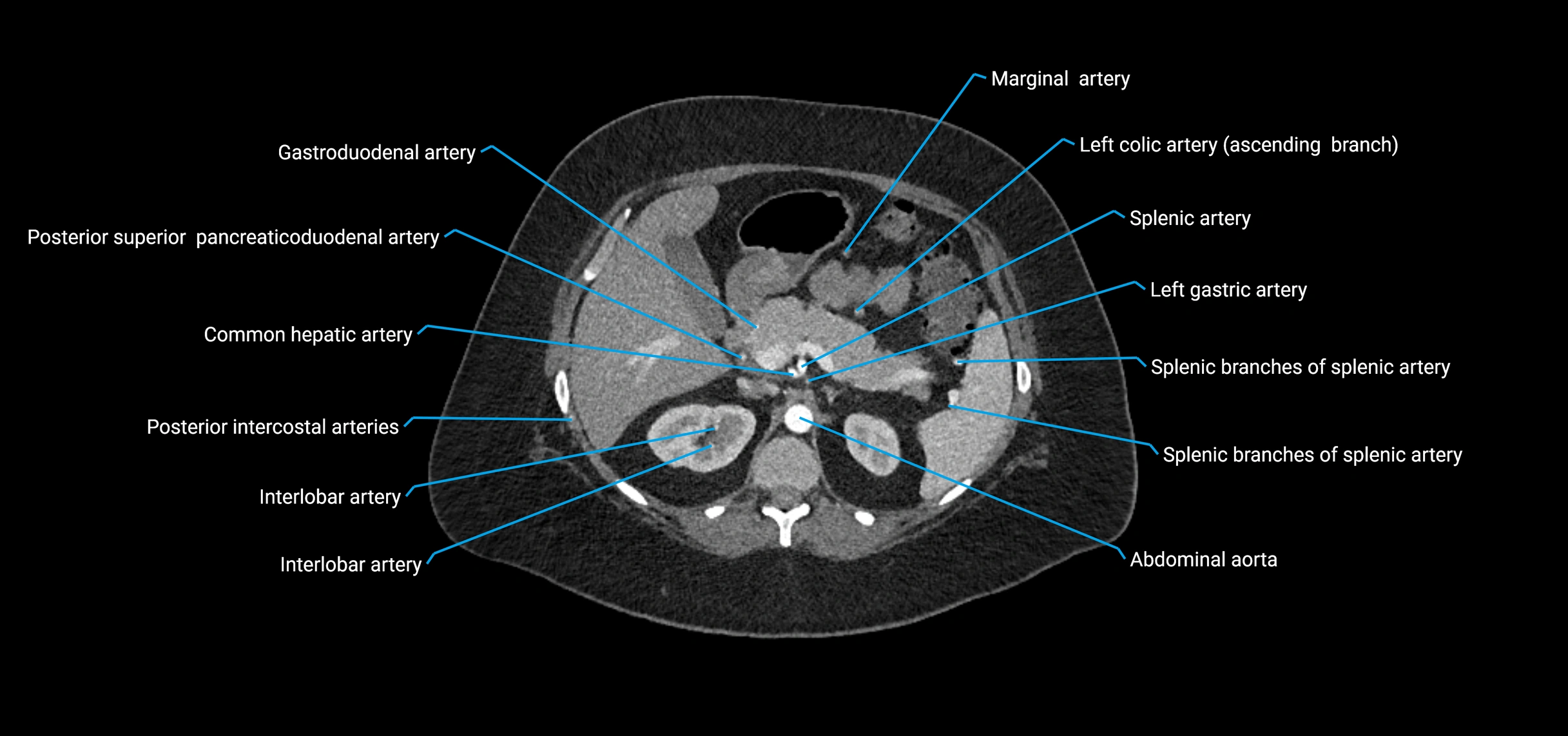 CTA abdomen axial cross sectional anatomy labelled image_53 (2).webp